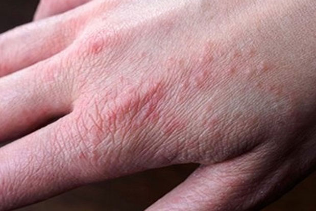 Dấu hiệu nào trên bàn tay cho thấy lượng đường huyết tăng cao vượt mức?