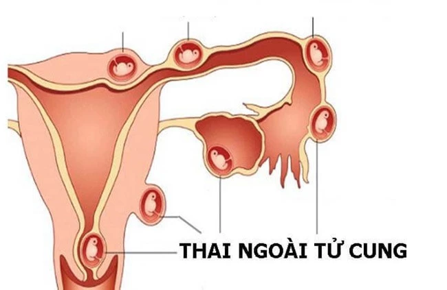 Uống thuốc tránh thai khẩn cấp có hại không? Những điều cần lưu ý khi uống thuốc tránh thai khẩn cấp - Ảnh 2.