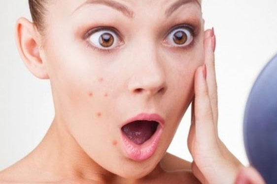 Mách bạn 5 cách trị mụn tuổi dậy thì hiệu quả nhanh