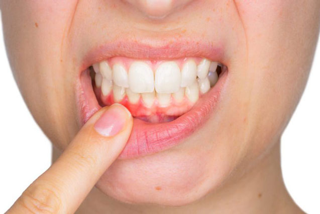 5 dấu hiệu ở miệng cho thấy gan đang bị tổn thương nghiêm trọng, mắc 1 điểm cũng cần đi khám ngay