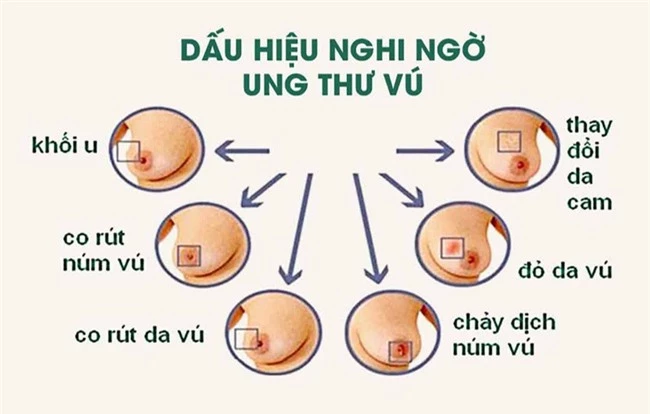 Ung thư vú: Dấu hiệu nhận biết và biện pháp phòng ngừa - Ảnh 2.