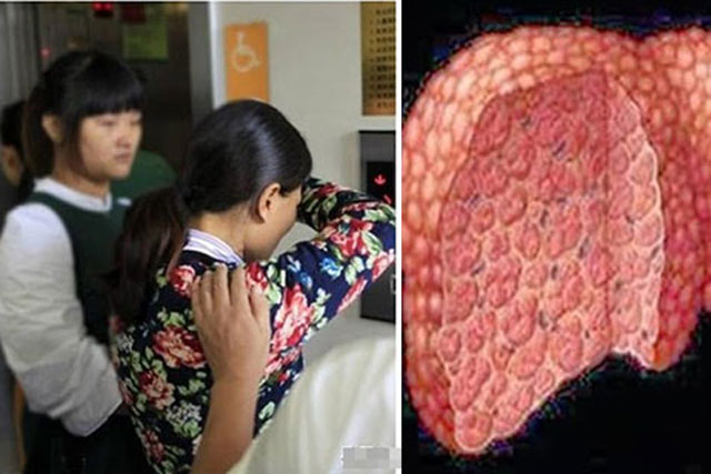 3 thói quen khi ngủ dậy vào buổi sáng hại gan hơn uống rượu: Nhiều người suy gan vẫn không biết vì sao