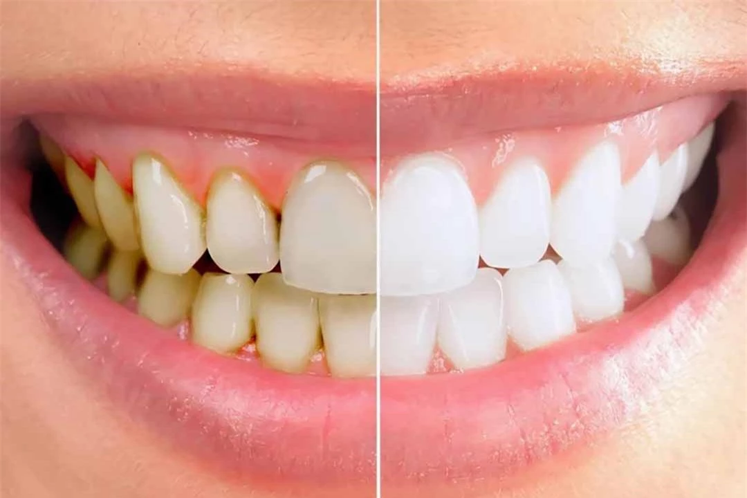 Cần lưu ý gì sau khi lấy cao răng?