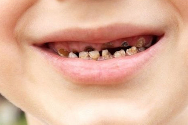 Vì sao răng sữa của bé bị mủn và 3 phương pháp khắc phục hiệu quả