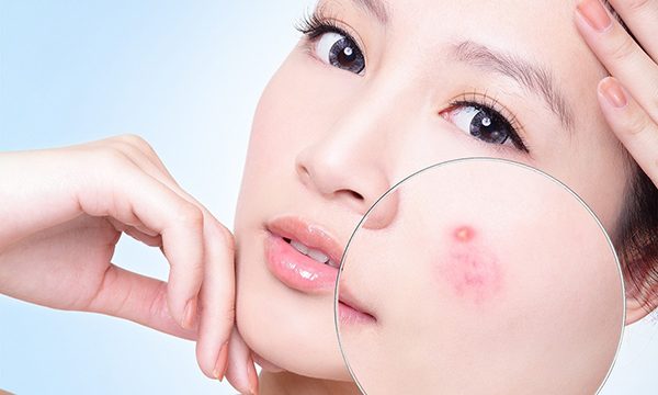 5 loại mặt nạ mật ong cho từng loại da chị em nên áp dụng ngay tại nhà