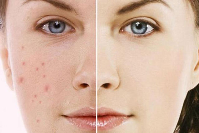 Cách trị mụn thâm từ những nguyên liệu thiên nhiên an toàn, hiệu quả