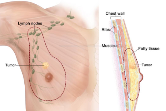 Dấu hiệu nhận biết bệnh ung thư vú ở nam giới