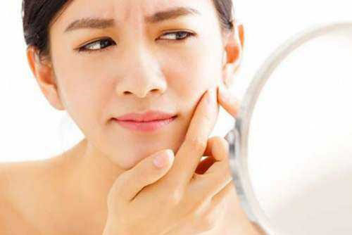 Thổi bay nỗi lo mụn dậy thì bằng các nguyên liệu rẻ bèo, dễ kiếm giúp lấy lại sự tự tin