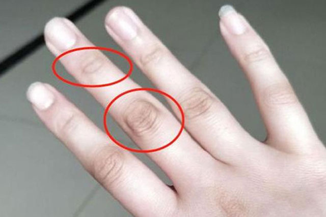 4 dấu hiệu bất thường ở ngón tay giữa cảnh báo gan suy yếu, hi vọng bạn không có cái nào