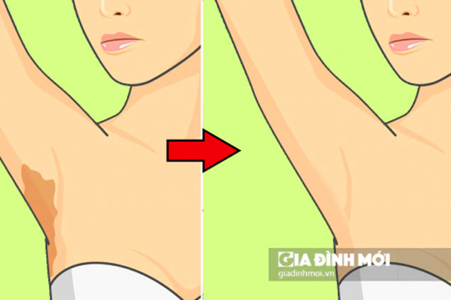 3 thực phẩm trị thâm nách hiệu quả giúp da mịn màng, trắng sáng không cần đến spa