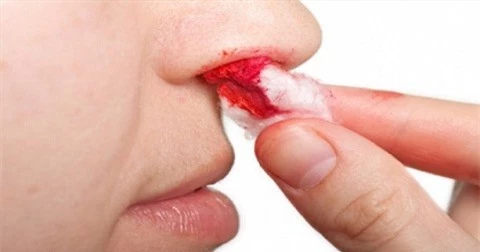 Dấu hiệu cho biết nguy cơ mắc ung thư vòm họng là hay chảy máu cam