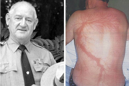 Người đàn ông bị sét đánh 7 lần liên tục, cơ thể tổn thương từ bên ngoài đến nội tạng mà vẫn sống sót