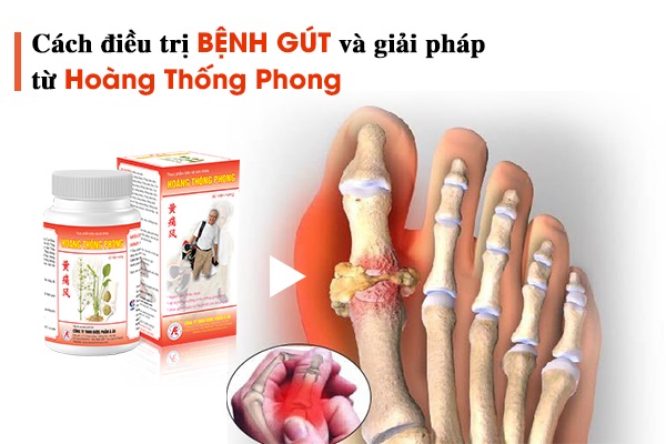 Cách điều trị bệnh gút và giải pháp từ sản phẩm Hoàng Thống Phong