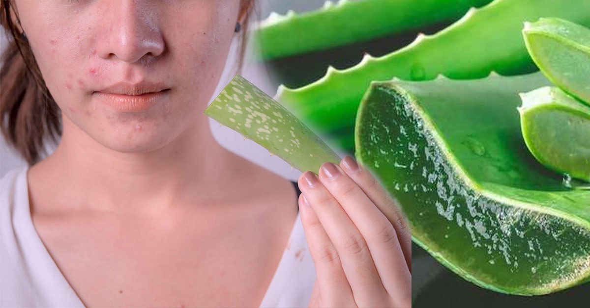 Tuyển tập trị mụn bằng nha đam “bai bai” làn da khuyết điểm