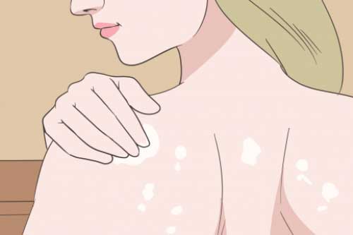 5 mẹo ngăn ngừa mụn cơ thể hiệu quả từ trong ra ngoài