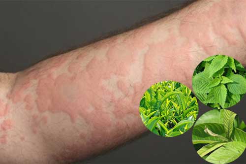 4 loại lá cây có sẵn trong vườn nhà, dùng để đun nước tắm chữa dị ứng nổi mề đay rất tốt