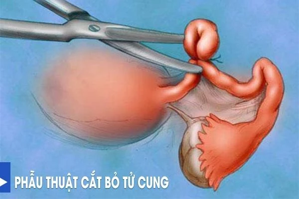 Thực hiện cắt bỏ tử cung để điều trị lạc nội mạc tử cung.