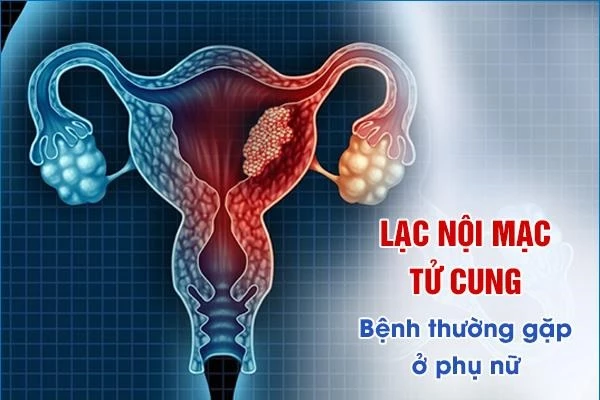 Lạc nội mạc tử cung có thể xuất hiện tại nhiều cơ quan khác nhau.