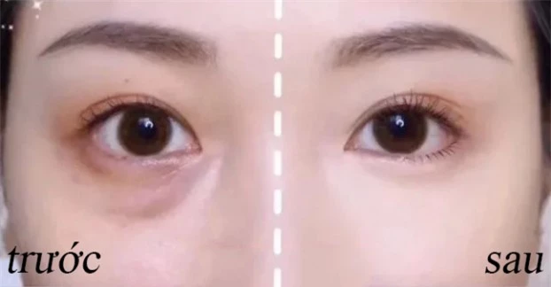 5 cách trị thâm quầng mắt bằng phương pháp tự nhiên giúp nhan sắc thăng hạng tức thì 0