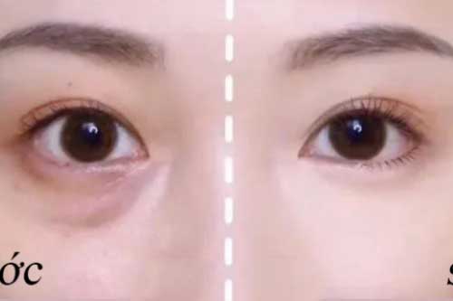 5 cách trị thâm quầng mắt bằng phương pháp tự nhiên giúp nhan sắc thăng hạng tức thì