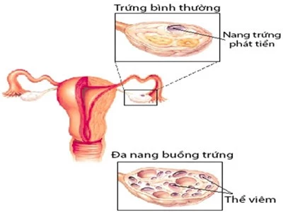 Thuốc tránh thai có tác dụng hỗ trợ điều trị hội chứng buồng trứng đa nang