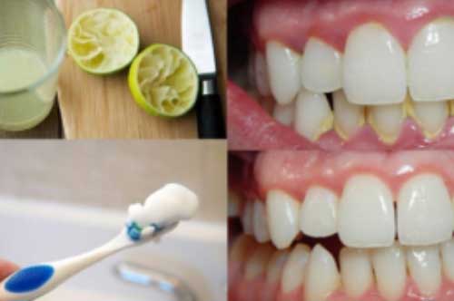 6 cách làm sạch cao răng tại nhà từ nguyên liệu tự nhiên, răng trắng bóng, giảm hôi miệng