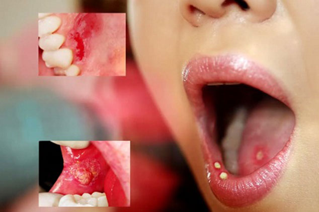 Ung thư tuyến nước bọt dễ nhầm với nhiệt miệng