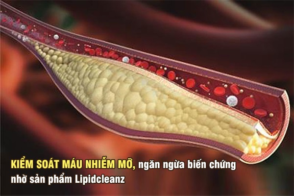 Kiểm soát máu nhiễm mỡ, ngăn ngừa biến chứng nhờ Lipidcleanz