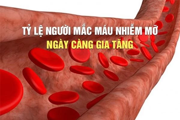 Máu nhiễm mỡ tình trạng lượng mỡ trong máu tăng cao trên ngưỡng bình thường.