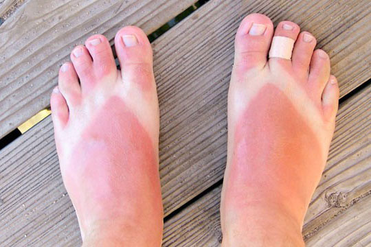 'Thần dược' lô hội trị vết phỏng rộp do cháy nắng