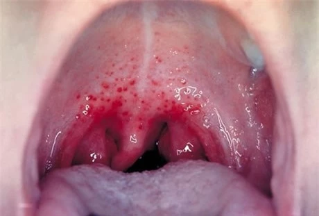 Nguy cơ ung thư vòm họng di căn chiếm 40-85% 