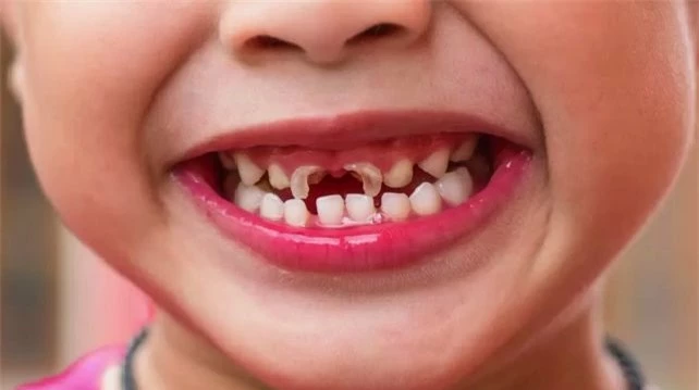 Sâu răng ở trẻ em là gì? Điều trị sâu răng ở trẻ em bằng cách nào? - Ảnh 3.