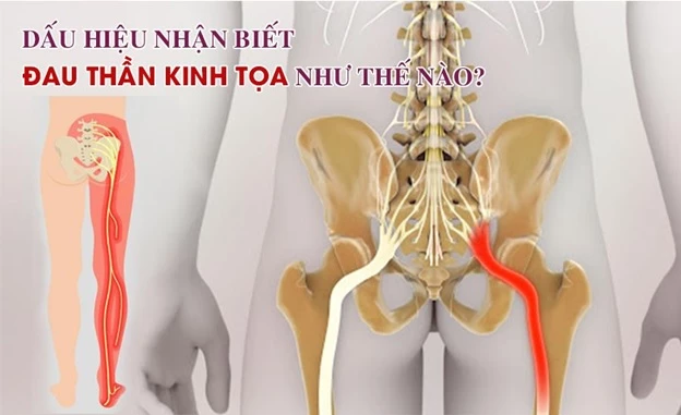 Đau thần kinh tọa được đặc trưng bởi các cơn đau từ thắt lưng chạy xuống hông, chân.