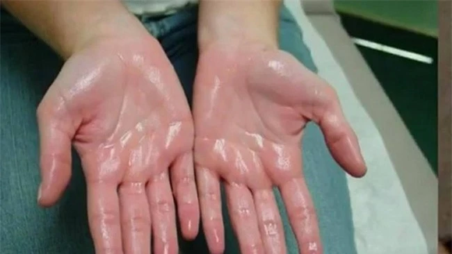 Nguyên nhân ra mồ hôi tay và 12 cách chữa mồ hôi tay hiệu quả - Ảnh 1.