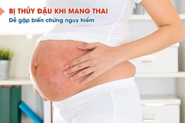 Phụ nữ mang thai mắc thủy đậu thì em bé dễ bị dị tật.