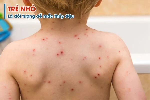 Trẻ nhỏ, người có sức đề kháng suy giảm rất dễ mắc bệnh thủy đậu.