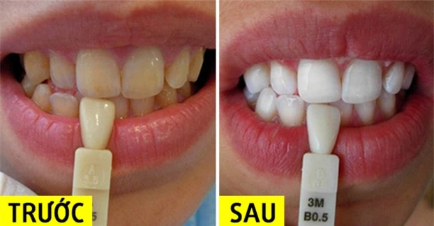 Vì sao đánh răng hàng ngày mà răng vẫn bị ố vàng? 5 cách giúp răng trắng hơn ngay tại nhà 0