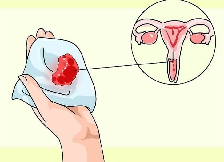 Ung thư cổ tử cung do vi khuẩn HPV gây ra