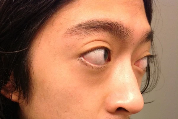 Người bị bướu đa nhân tuyến giáp có thể gặp phải tình trạng lồi mắt, gây mất thẩm mỹ.
