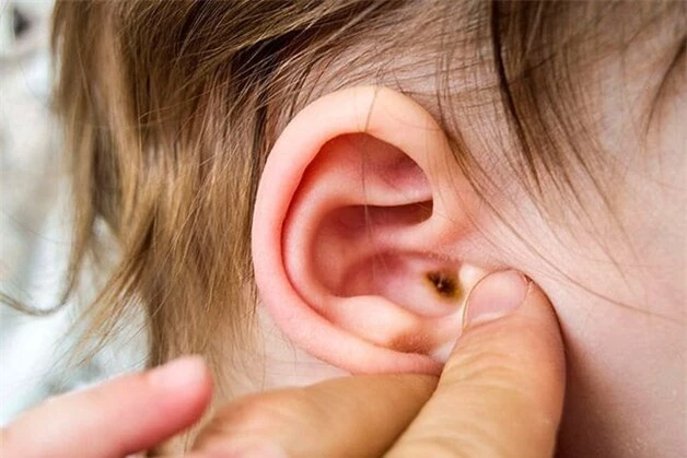 Nguyên nhân không ngờ gây bệnh viêm tai giữa ở trẻ