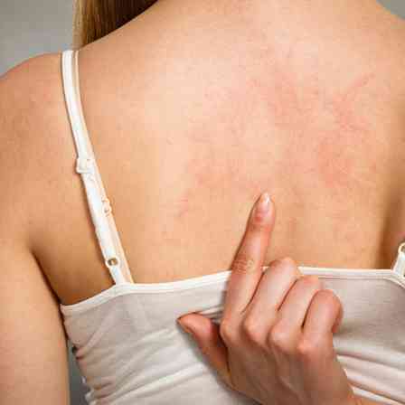 Cải thiện vấn đề về da thường gặp trong mùa đông