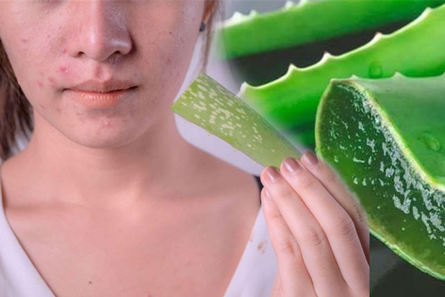 Tuyển tập các tips hay ho trị mụn bằng nha đam đơn giản, hiệu quả