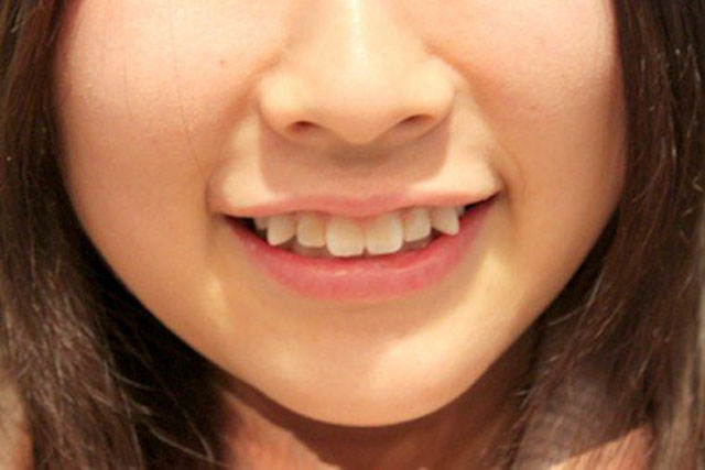 Nhìn tướng răng phụ nữ biết số giàu sang hay nghèo hèn: Răng cửa có khe hở là tài vận không vượng