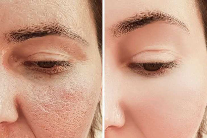 Học lỏm 7 mẹo thu nhỏ lỗ chân lông của chuyên gia cực hiệu quả