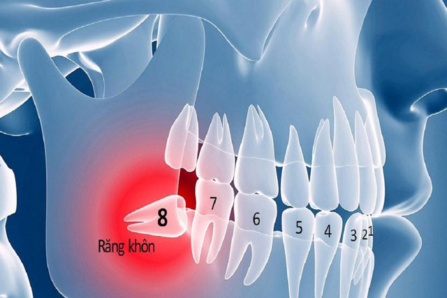 Nhổ răng khôn có thể cải thiện vị giác của bạn?