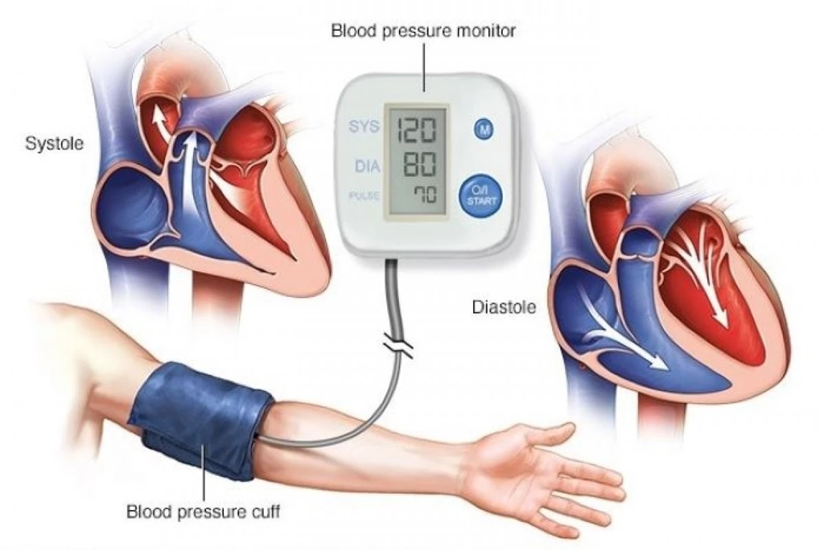 THA là một bệnh lý trong đó trị số HA lúc nghỉ cao hơn mức bình thường.