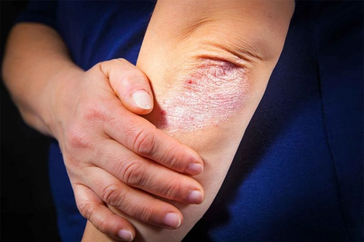 Bệnh vảy nến và bệnh chàm eczema: Khi bạn ngủ không đủ giấc, lượng hormone cortisol gây căng thẳng trong cơ thể sẽ tăng cao, từ đó kích thích các bệnh lý về da như bệnh vảy nến hay bệnh chàm./.