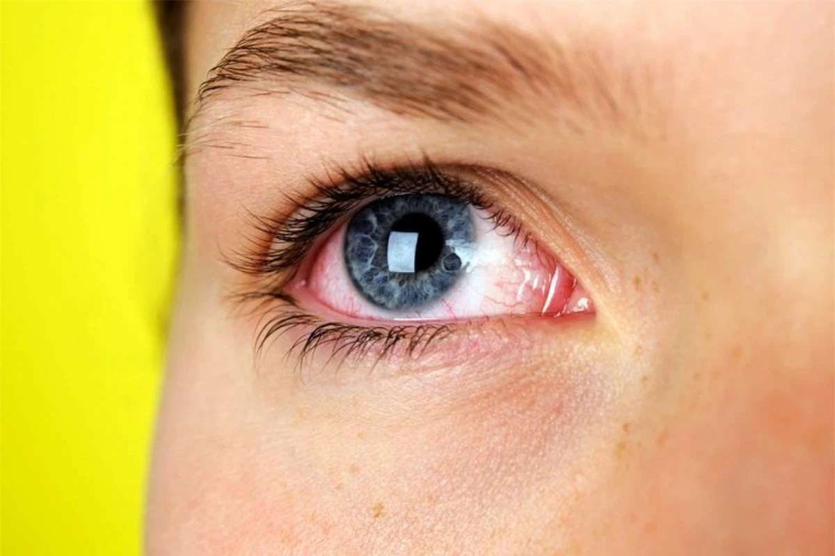 Đỏ mắt: Tình trạng đỏ mắt là cách cơ thể biểu hiện sự kích ứng, cũng giống như khi ta bị mẩn ngứa trên da. Trong trường hợp này, bạn nên dùng nước nhỏ mắt tinh khiết thay vì loại thuốc nhỏ mắt dược liệu.