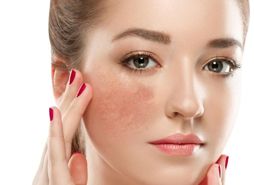 Gợi ý những cách loại bỏ đốm đen cho bạn làn da sáng mịn