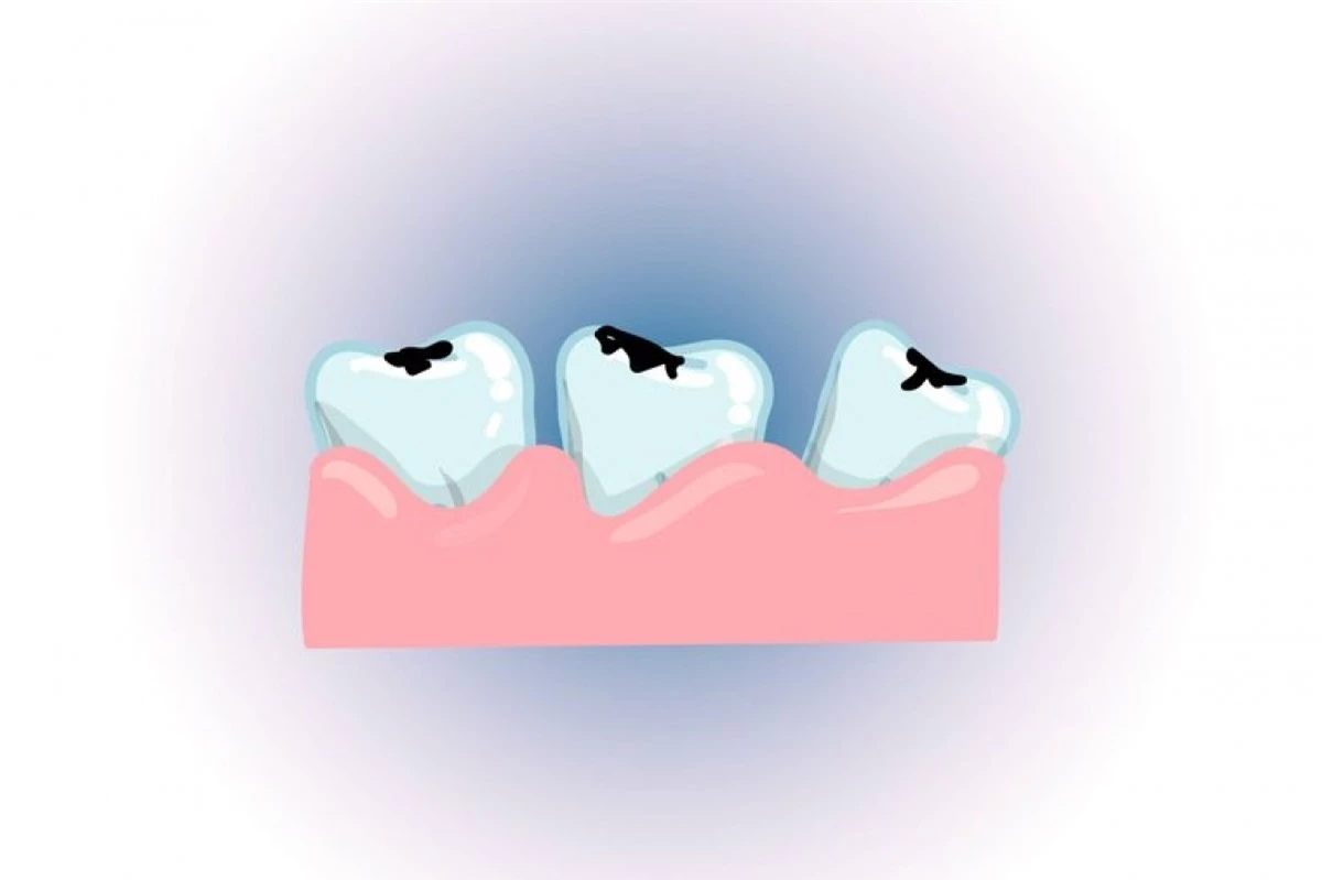 Khiến răng nhạy cảm: Nhai đá lạnh còn khiến răng bị nứt mẻ, gây sâu răng và sưng đau cơ hàm. Chuyên gia cũng cảnh báo rằng nhai đá lạnh có thể khiến răng trở nên cực kỳ nhạy cảm, ê buốt khi ăn đồ nóng hoặc đồ lạnh.